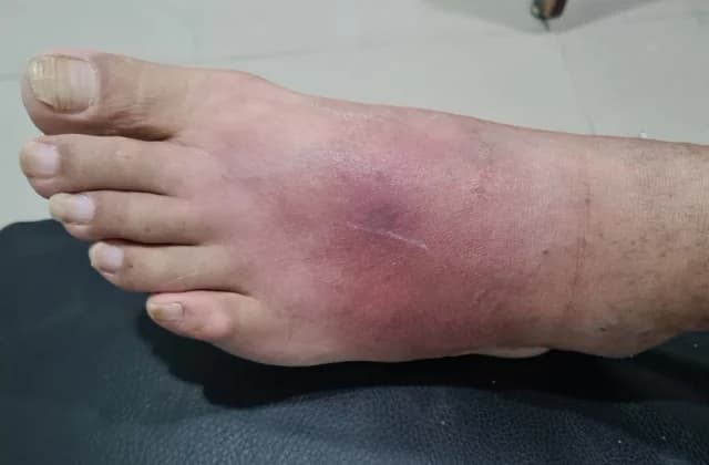 Infecciones recurrentes