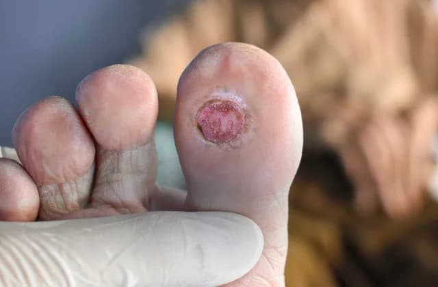 Úlceras neuropáticas